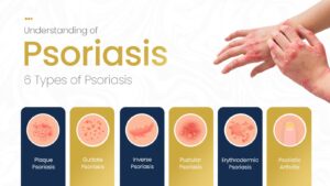 Understanding of Psoriasis