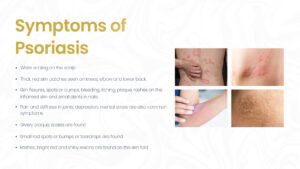 Symptoms of Psoriasis