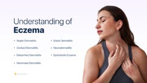 Understanding of eczema