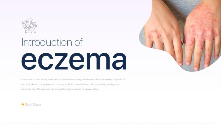 Eczema