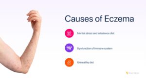 causes of eczema