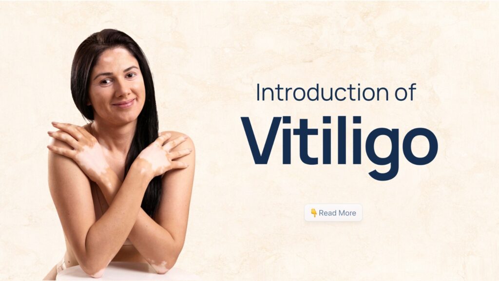 Introduction to vitiligo