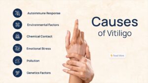 Causes of vitiligo