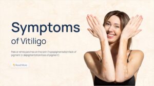 Symptoms of vitiligo