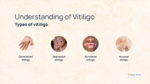 Understanding of Vitiligo