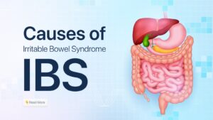 Causes of IBS